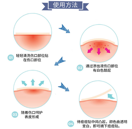 韩国痘痘贴的使用方法