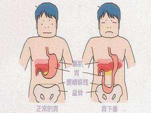 胃下垂怎么办