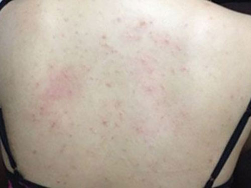 背部长痘的原因